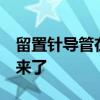 留置针导管在婴儿血管里漂移5年，终于取出来了