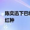 陈奕迅下巴缝30多针后首露面 伤疤未愈仍显红肿