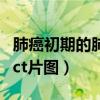 肺癌初期的肺部ct报告图片（肺癌的早期症状ct片图）